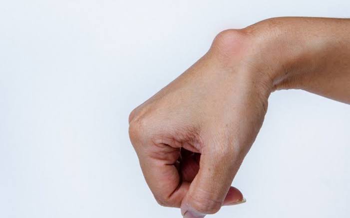 What is a wrist ganglion? |