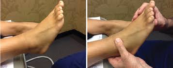 Related searches for ligament in ankle: A Guide To Conservative Care For Ankle Sprains Podiatry Today