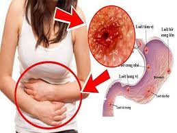 Check spelling or type a new query. Táº¿t Nay Lam Sao Thoat Khá»i Am áº£nh Viem Dáº¡ Day