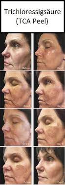 The bha in the ordinary aha 30% + bha 2% peeling solution refers to salicylic acid, a member of the beta hydroxy acids family. 100 Peeling Ideen Chemisches Peeling Peeling Seborrhoische Dermatitis