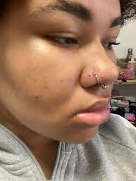 Dose anyone know what this bump in my nose piercing is, and if you do how  do remove it?