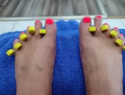 Image result for Clubbing nails feet