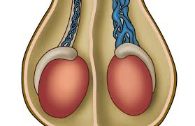 Image result for Varicocele