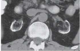 Image result for Nephrolithiasis Imaging