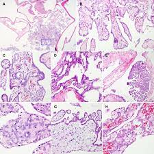 These tumors tend to be small ( fig. Clinicopathological Characteristics Of Well Differentiated Papillary Mesothelioma Of The Peritoneum A Single Institutional Experience Of 12 Cases In Vivo
