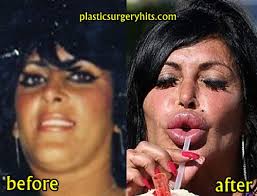 Some of the most com. Big Ang Plastic Surgery Before And After Plastic Surgery Hits
