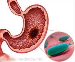 Screening is testing for a disease, such as cancer, in people without symptoms. Early Immunotherapy Better In Stomach Cancer If Combined With Chemo