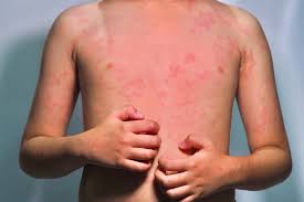 Image result for Hives