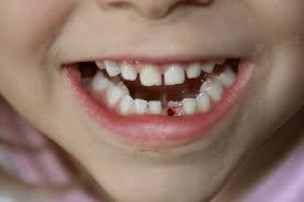 Are Red Spots On My Baby S Gums Normal Ask The Dentist