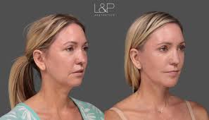 Image result for Webbed Neck