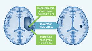 Image result for Stroke Pathophysiology