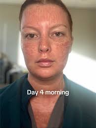 Laser Resurfacing After Care