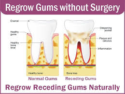 Regrow Receding Gums Receding Gums Periodontal Disease Gum Disease