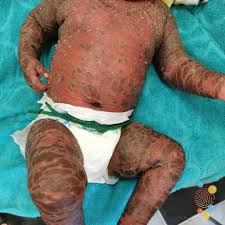 Image result for Ichthyosis