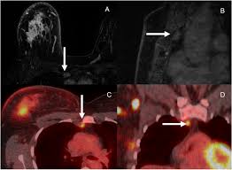 ٢٢ ذو الحجة ١٤٤١ هـ. Extra Axillary Nodal Metastases In Breast Cancer Comparison Of Ultrasound Mri Pet Ct And Ct Clinical Imaging