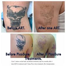 Questions to ask your aesthetic plastic surgeon. Does Picosure Laser Tattoo Removal Work Quora