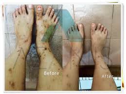 Coba perawatan mikrodermabrasi untuk menghilangkan luka parut atrofik. Cara Menghilangkan Parut Jerawat Di Badan