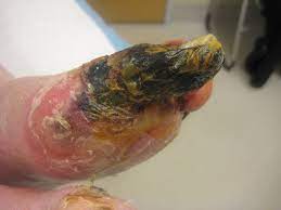 Icd 10 code diabetic foot ulcer wound. Diabetic Foot Ulcers Overview