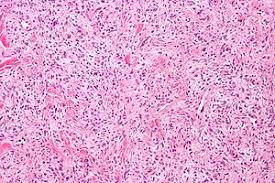 Gata3, breast cancer, urothelial cancer, choriocarcinoma, endodermal sinus tumor, chromophobe renal carcinoma, mesothelioma, immunohistochemistry. Solitary Fibrous Tumor Wikipedia