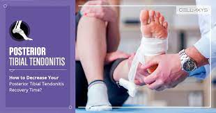 How To Decrease Your Posterior Tibial Tendonitis Recovery Time Cellaxys