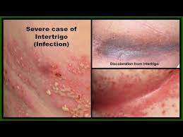 Image result for heat rash under breasts