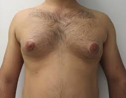 Image result for Gynecomastia
