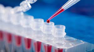 USA - New blood test may detect SARS-CoV-2 antibodies - RIS.WORLD