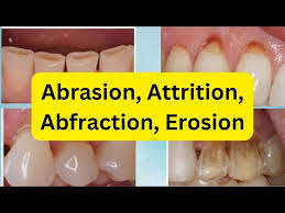 Image result for Tooth Abrasion
