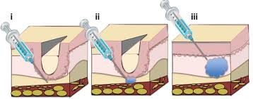 Image result for Dermal Filler Injection