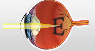 If your vision is good enough to drive and you are not too light sensitive, you could resume driving. Top 5 Tips To Minimize Cataract Surgery Recovery Time Mces