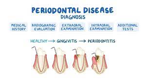 Diagnosis Of Periodontitis Osmosis