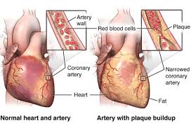 Left coronary artery right coronary artery coronary circulation. Coronary Artery Disease And Chest Pain Uchicago Medicine