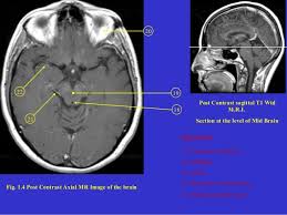 Mri Brain Anatomy Dr Muhammad Bin Zulfiqar