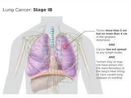 Check spelling or type a new query. Lung Cancer Staging Lungevity Foundation