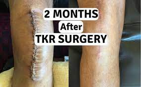 Will total knee replacement help my problem? 2 Months After Tkr Surgery Scars Pain And Progress