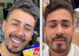 Mas, antes de o amor reinar entre carlinhos maia e lucas guimarães, ele precisou ser insistente. Carlinhos Maia Muda Formato Do Rosto Com Procedimento E Resultado Chama Atencao