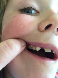 The gum abscess involves only the gingiva of the gums. Tooth Abscess Mrs Morton Mumsnet