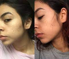 Let's see the ways get rid of pimple marks, spots, acne scars you might have tried the expensive market products but these cheap and easy homemade face packs work like wonders to remove those challenging acne scars and give a smooth and scar free skin. How To Remove Beauty Mark Bmo Show
