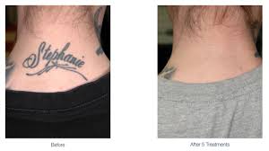 How long do tattoo removal treatments take? Laser Tattoo Removal Plastic Surgeon Parbhu Oculofacial Plastic Surgery