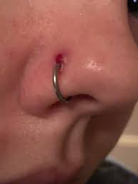Two Week Old Nose Piercing Told To Use Watered Down Tcp For A Week Piercing