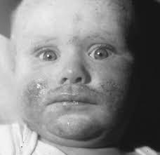 CLINICAL FEATURES OF ATOPIC DERMATITIS