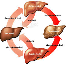Cacao, cafea, alcool (strict interzis). Ciroza Hepatica Alcoolica