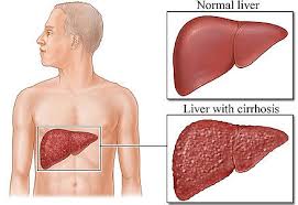 Apa penyakit hepatitis a itu berbahaya? Hepatitis B Apa Itu Loexie