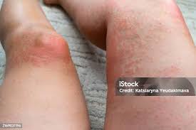 Image result for Photodermatitis