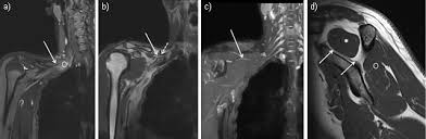 There are around 650 skeletal muscles within the typical human body. Nerves Around The Shoulder What The Radiologist Should Know