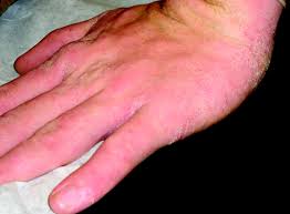 How to remove eczema on hands with foods that help? Hand Dermatitis Review Of Etiology Diagnosis And Treatment American Board Of Family Medicine