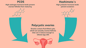 Polycystic ovary syndrome (pcos) is a hormonal disorder common among women of reproductive women with pcos may have infrequent or prolonged menstrual periods or excess male hormone. Is There A Link Between Pcos And Hypothyroidism