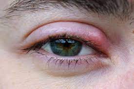 Jul 01, 2020 · a warm compress is the most effective way to treat a stye. What Causes An Eye Stye How To Get Rid Of A Stye Fast