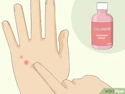 Can this 1 simple tip really kill bed bugs for good? How To Treat Bed Bug Bites 12 Steps With Pictures Wikihow