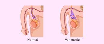 Die varikozele, auch krampfaderbruch genannt, ist eine eine meist links vorhandene dilatation und vermehrung des plexus pampiniformis am samenstrang. Was Ist Eine Varikozele Ursachen Symptome Und Behandlung